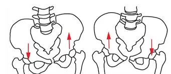 Lateral pelvic tilt