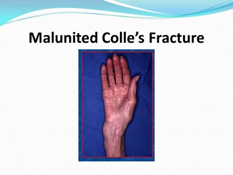 MalUnited Colles Fracture