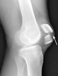 Patellar Fractures