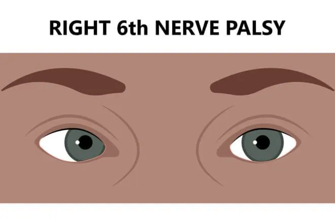 Abducens Nerve Palsy (Sixth-Nerve-Palsy)