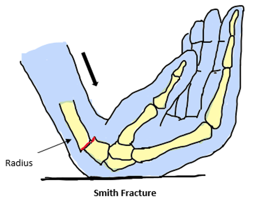 Smith Fracture - Cause, Symptoms, Treatment, Exercise