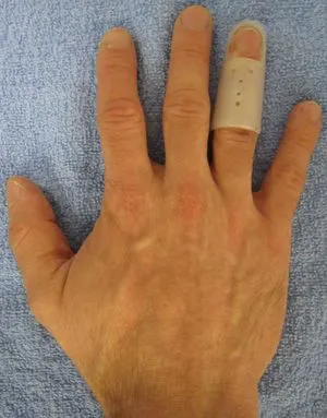 Mallt Finger Splint