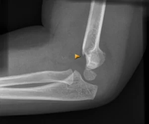 Read more about the article Supracondylar Fracture of Humerus