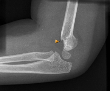 Supracondylar Humerus Fracture