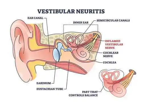 Vestibular Neuritis