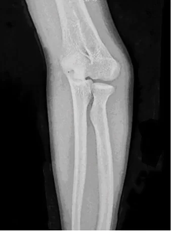 X-Ray of Cubitus Varus Deformity