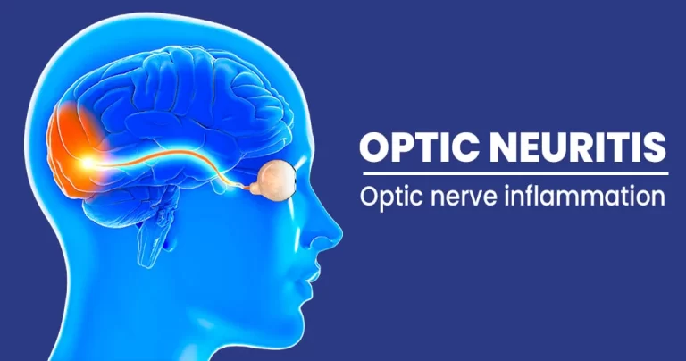 optic neuritis