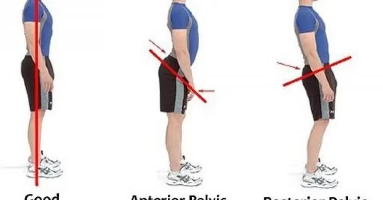 posterior pelvic tilt