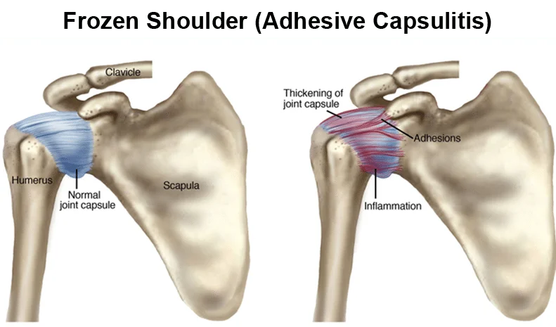 Adhesive Capsulitis