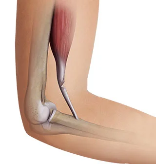 Biceps Tendon Rupture