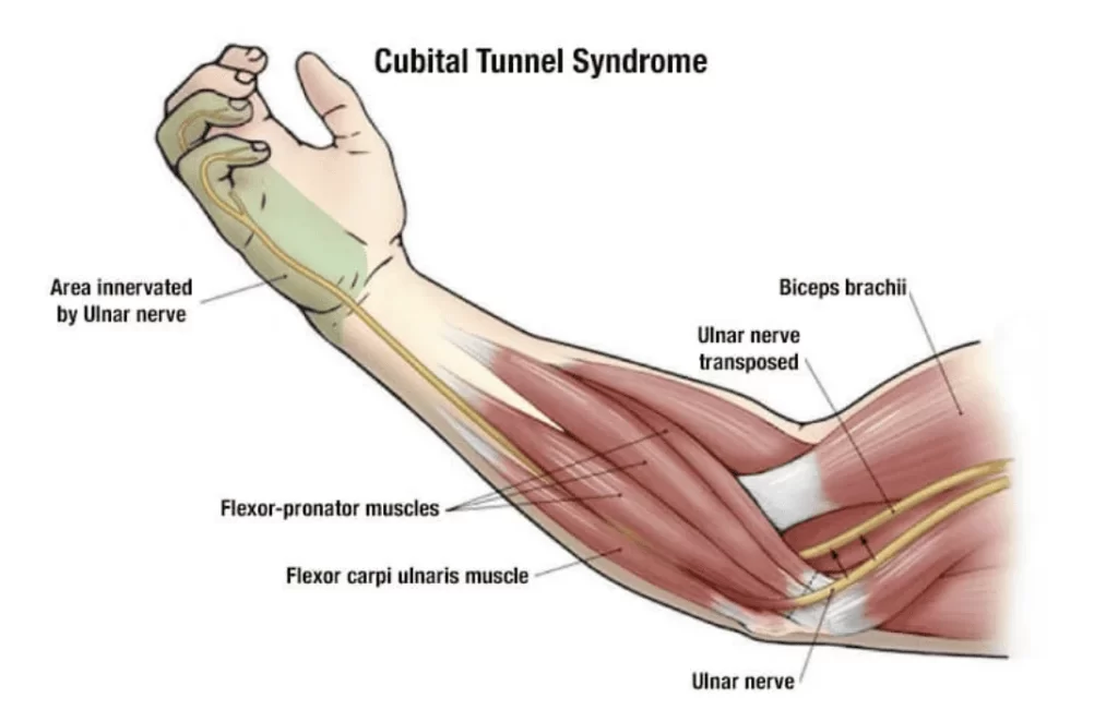 Cubital Tunnel Syndrome