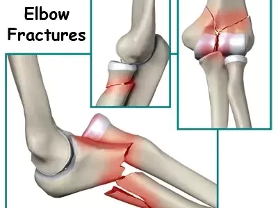 Elbow Fracture