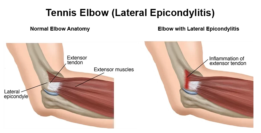 Lateral Elbow Tendinopathy