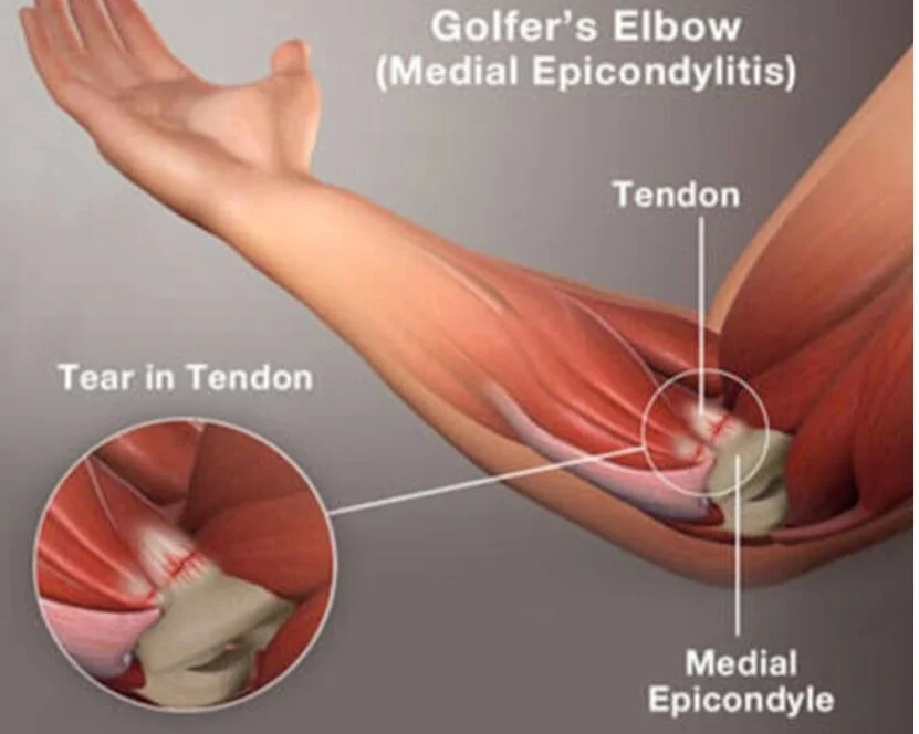 Medial Elbow Tendinopathy