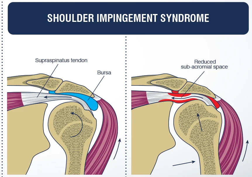 Shoulder Impingement