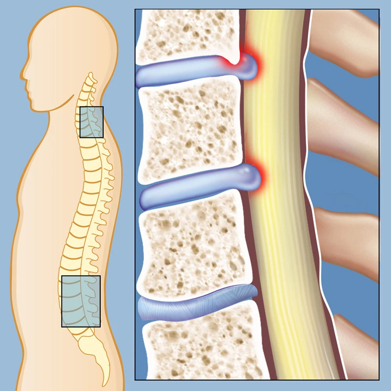 Spinal Stenosis