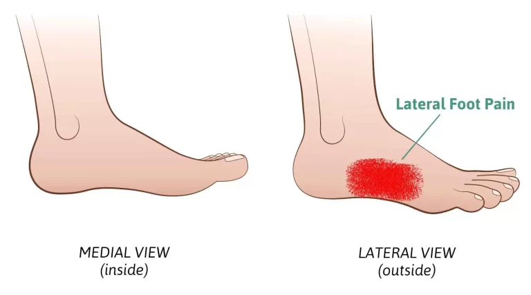 Sural-Neuritis