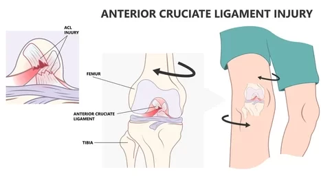 acl-injury-knee-tear-torn