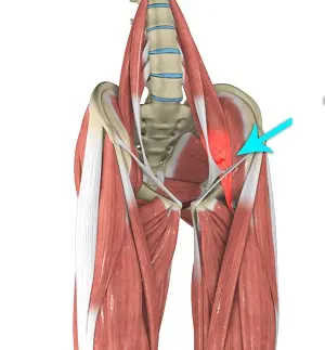 HIP FLEXOR STRAIN