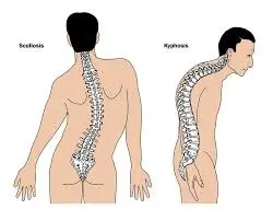 kyphosis-scoliosis