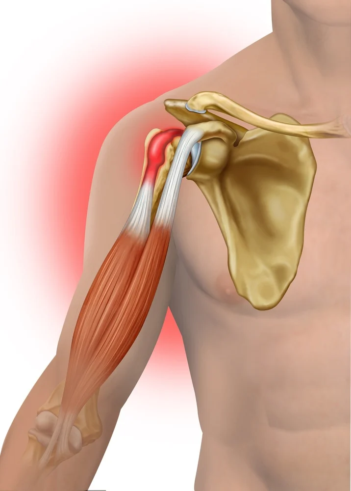 Biceps Tendinopathy