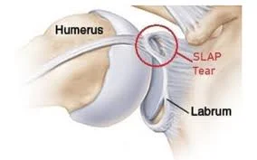 Labral Tears