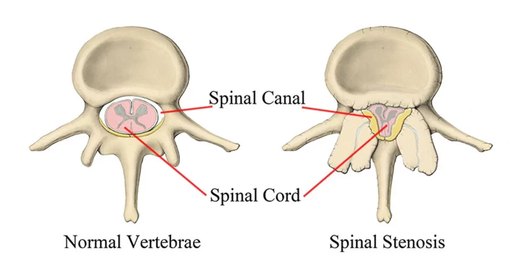 spinal-stenosis