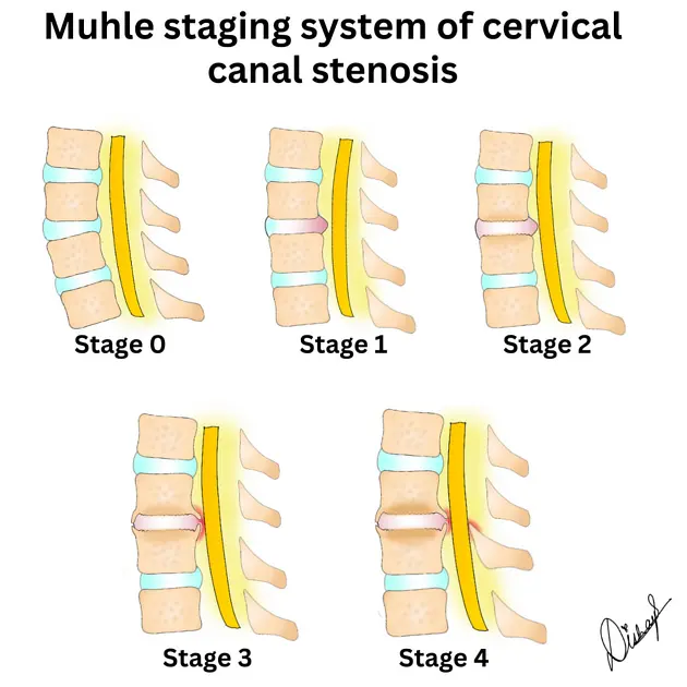 stages of spinal canal stenosis