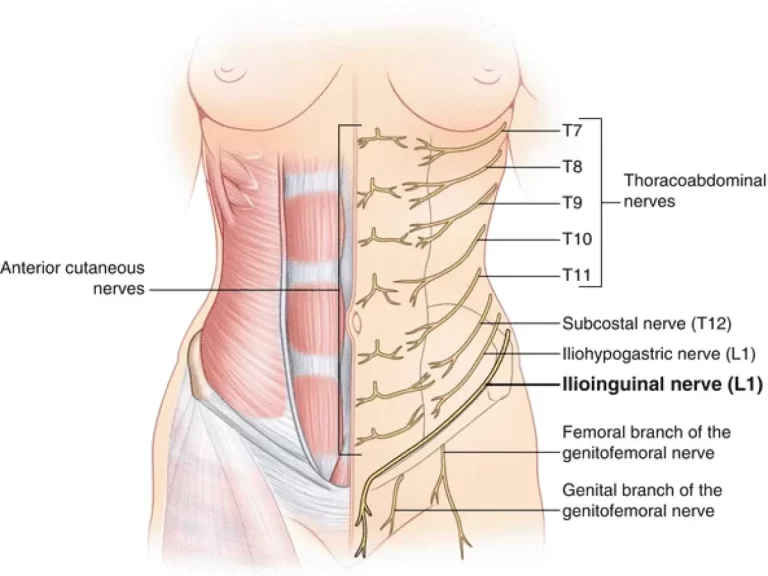 Ilioinguinal-Neuralgia