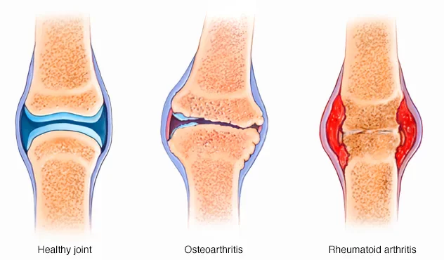 joint osteoarthritis