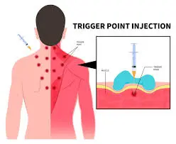 Triger point injections