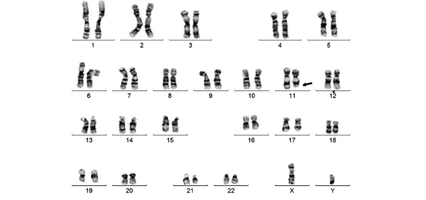 Genetic mutation in jacobsen syndrome