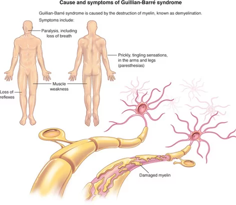 Guillain-Barre-syndrome