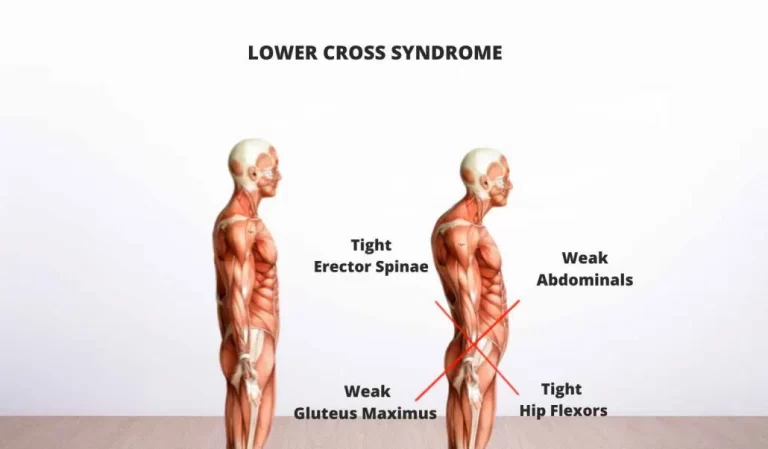 Lower Cross Syndrome