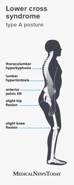 Lower Cross Syndrome Type A