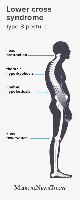 Lower Cross Syndrome Type B