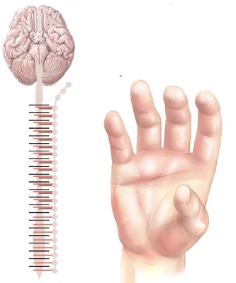 Shoulder Hand Syndrome