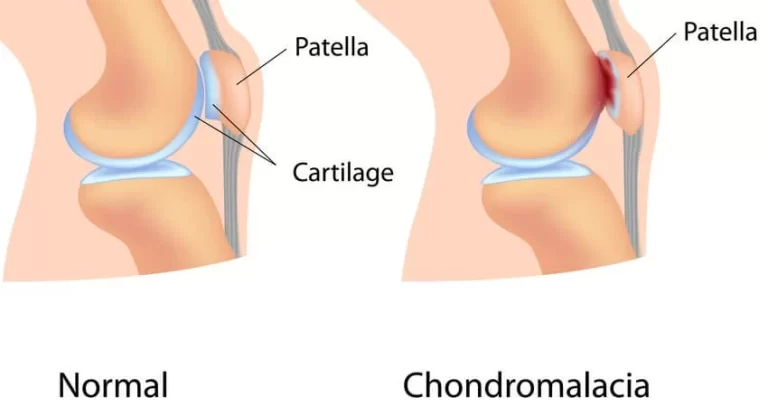 Chondromalacia Patella