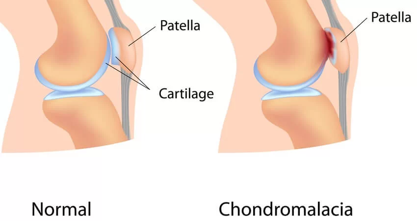 Chondromalacia Patella