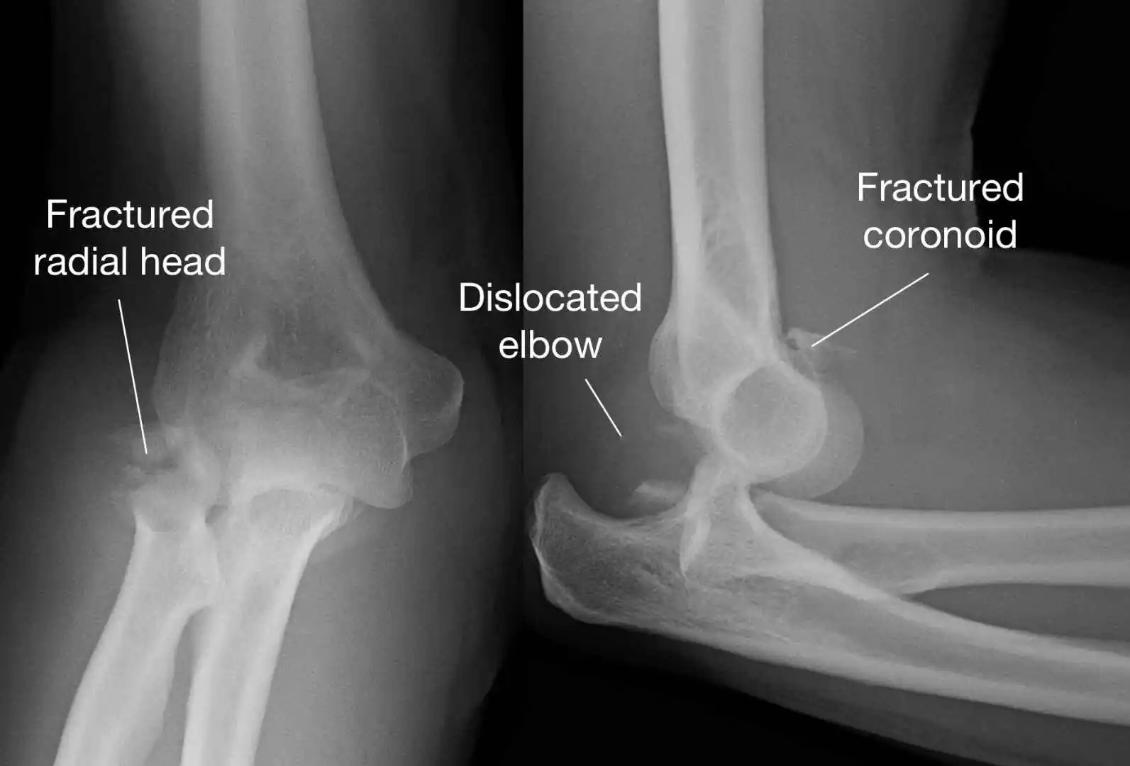 Elbow Dislocation