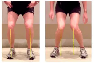 Exercise for Knee Varus Deformity