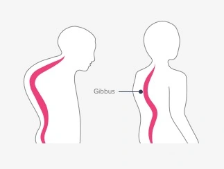 Gibbus Deformity