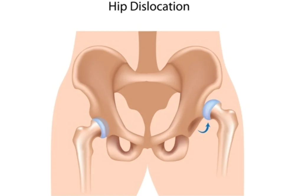 Hip-dislocation