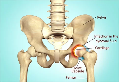 Hip-joint