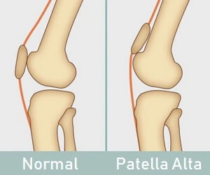 Patella Alta