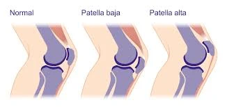 Patella Baja