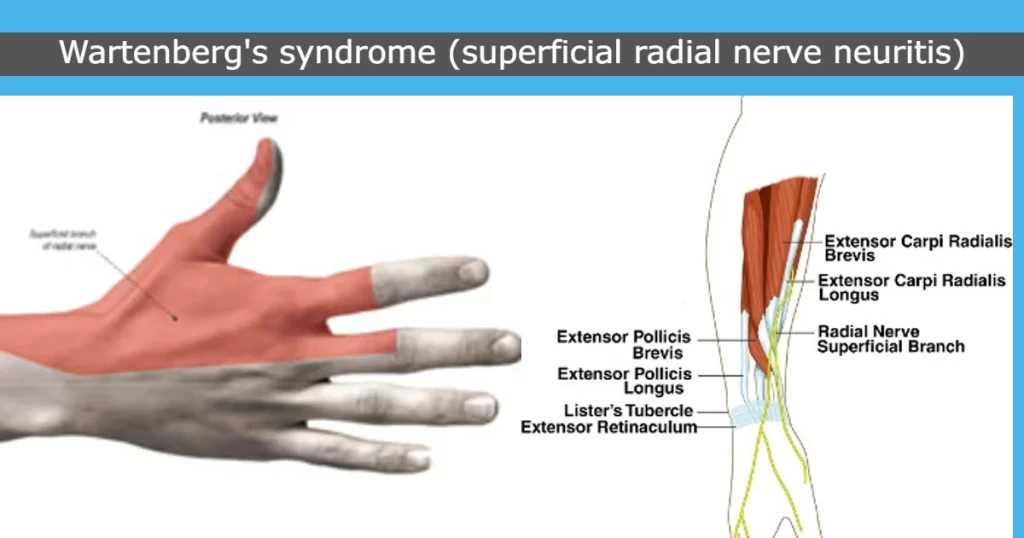 Cheiralgia Paresthetica (Warternberg syndrome)