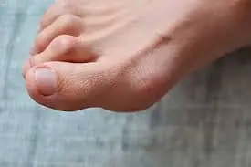 Exercise-for-Claw-Toe-Deformity