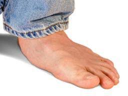 Flat Feet