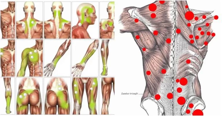 Muscle Knots